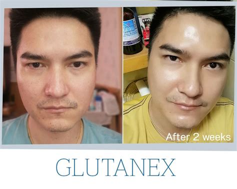 Before and After Glutathione Injection: What to Expect.